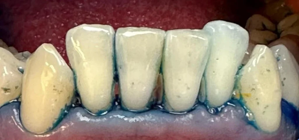 Matos Fogászati Szolgáltatások - Szájhigiénia - APDT