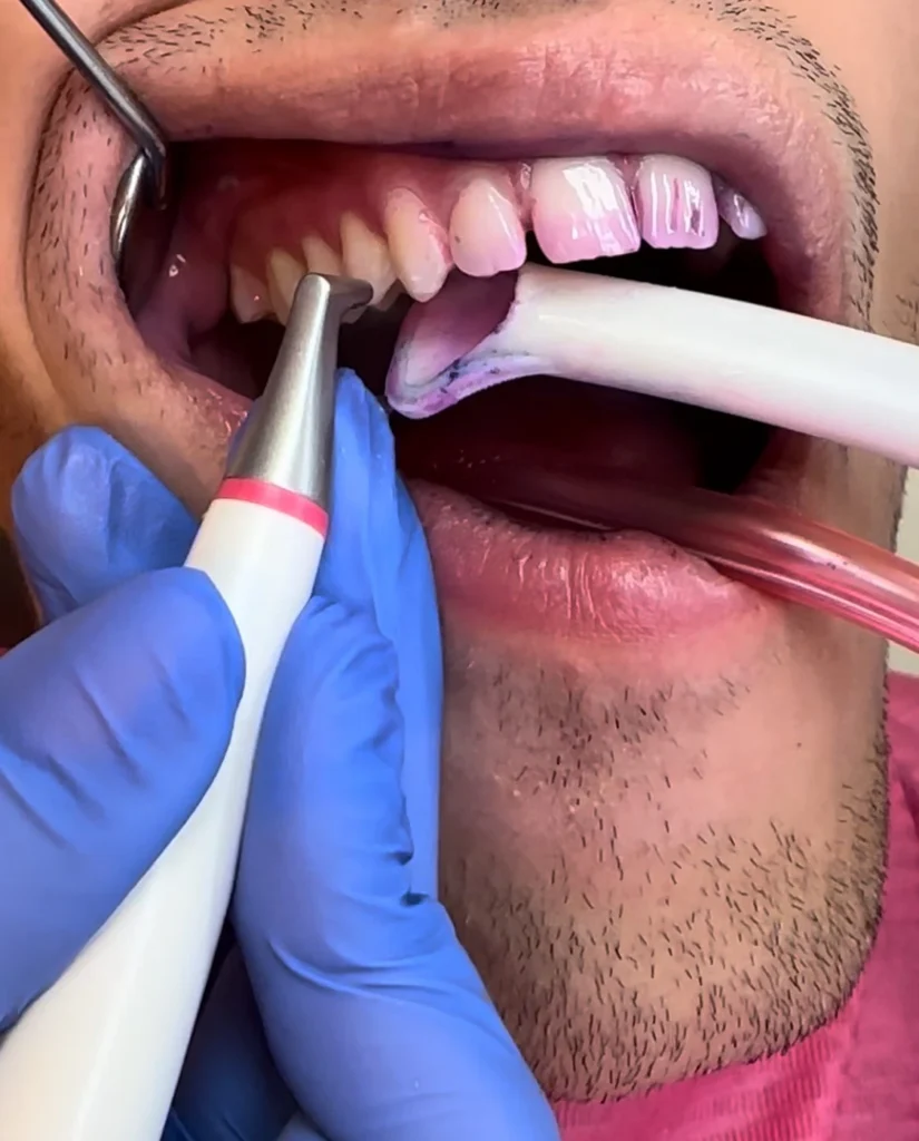 Matos Fogászati Szolgáltatások - Szájhigiénia - Biofil terápia