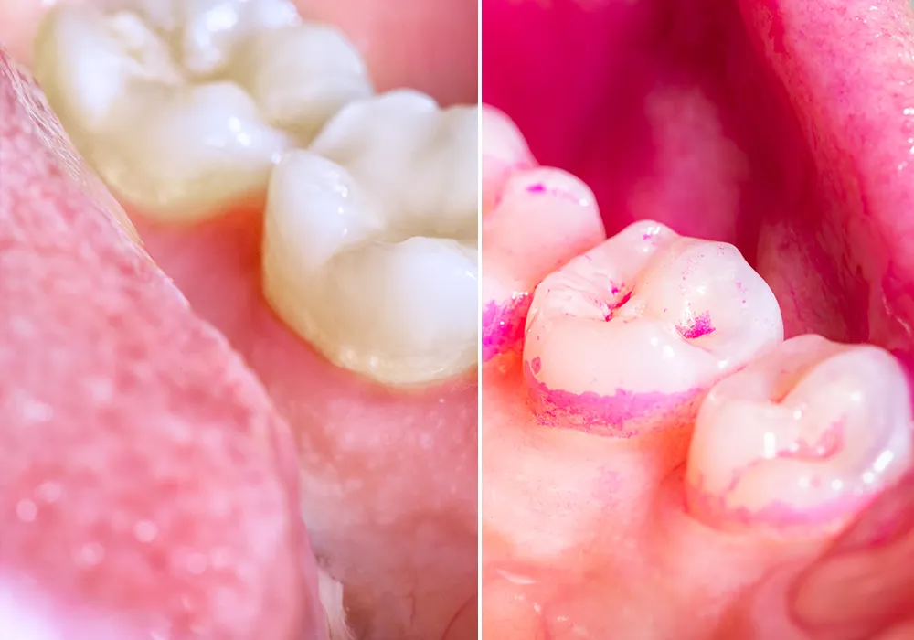 Matos Fogászati Szolgáltatások - Szájhigiénia - Plakkfestés